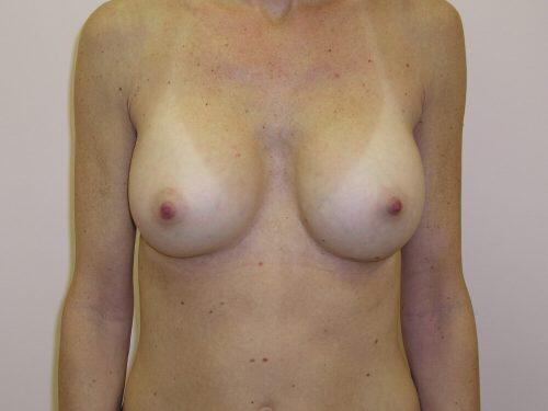 Breast Augmentation  Before & After Image