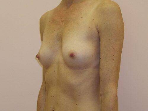 Breast Augmentation  Before & After Image