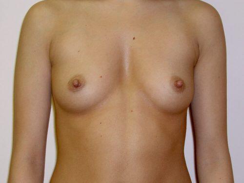 Breast Augmentation  Before & After Image