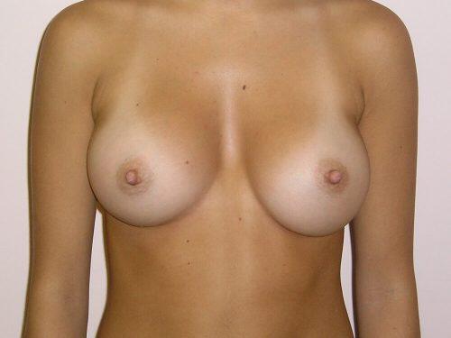 Breast Augmentation  Before & After Image