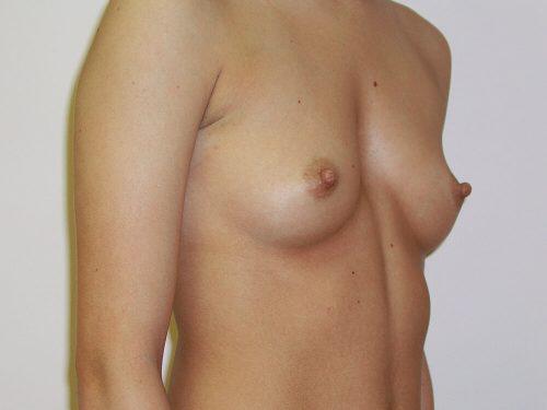 Breast Augmentation  Before & After Image