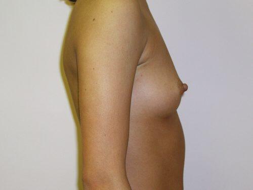 Breast Augmentation  Before & After Image