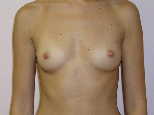 Breast Augmentation  Before & After Image