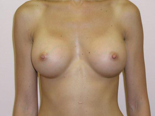 Breast Augmentation  Before & After Image