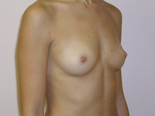 Breast Augmentation  Before & After Image