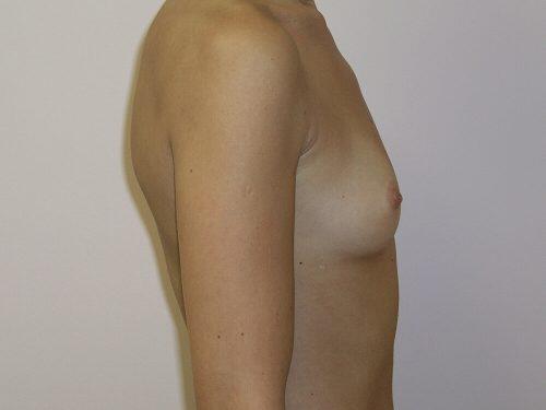 Breast Augmentation  Before & After Image