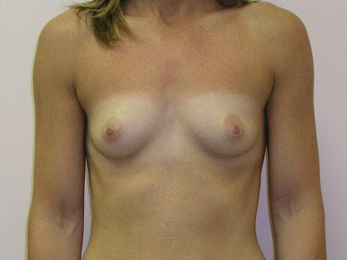 Breast Augmentation  Before & After Image