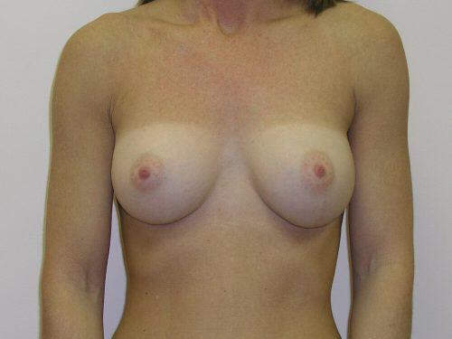 Breast Augmentation  Before & After Image