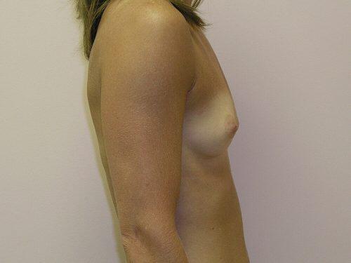 Breast Augmentation  Before & After Image