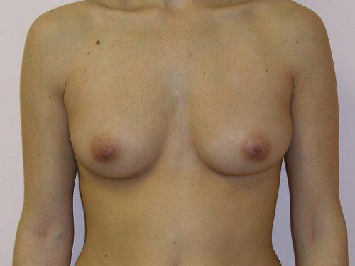 Breast Augmentation  Before & After Image