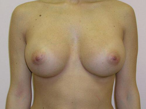 Breast Augmentation  Before & After Image