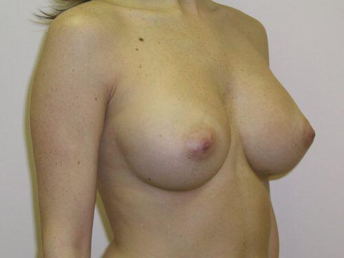 Breast Augmentation  Before & After Image