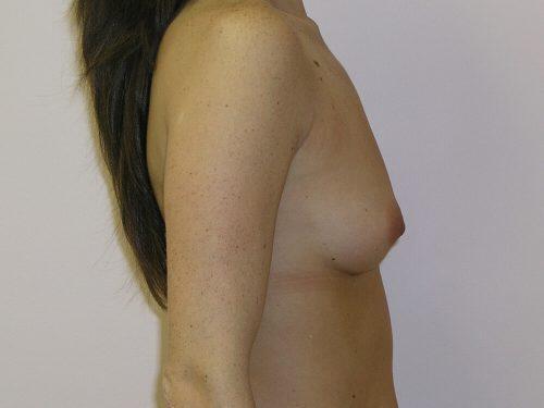 Breast Augmentation  Before & After Image