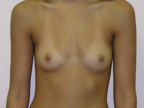 Breast Augmentation  Before & After Image