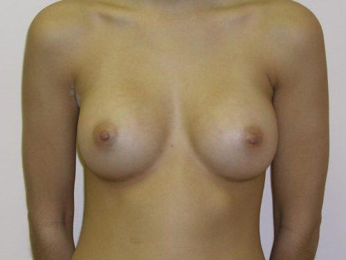 Breast Augmentation  Before & After Image