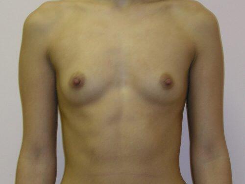 Breast Augmentation  Before & After Image