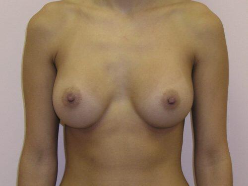 Breast Augmentation  Before & After Image