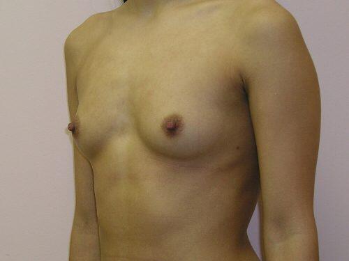 Breast Augmentation  Before & After Image