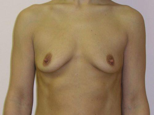 Breast Augmentation  Before & After Image