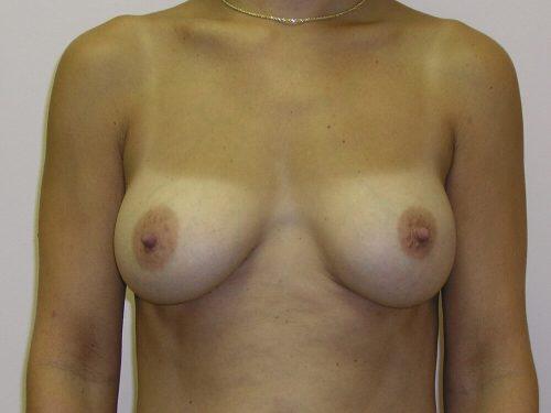 Breast Augmentation  Before & After Image