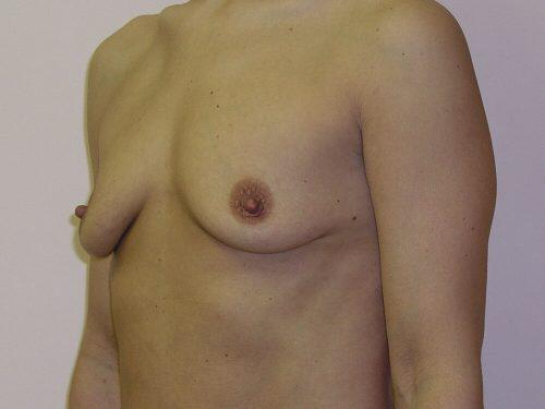 Breast Augmentation  Before & After Image