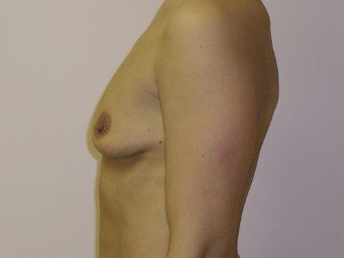 Breast Augmentation  Before & After Image