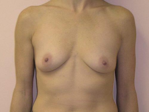 Breast Augmentation  Before & After Image