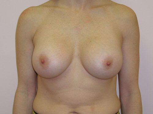 Breast Augmentation  Before & After Image