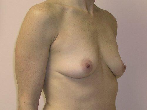 Breast Augmentation  Before & After Image