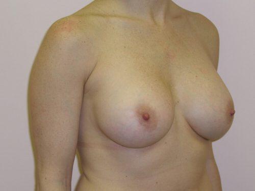 Breast Augmentation  Before & After Image