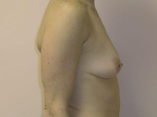 Breast Augmentation  Before & After Image