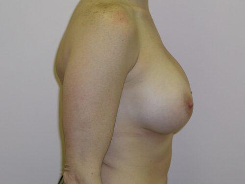 Breast Augmentation  Before & After Image