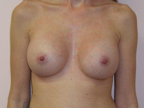 Breast Augmentation  Before & After Image