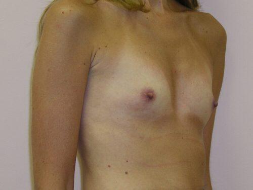 Breast Augmentation  Before & After Image