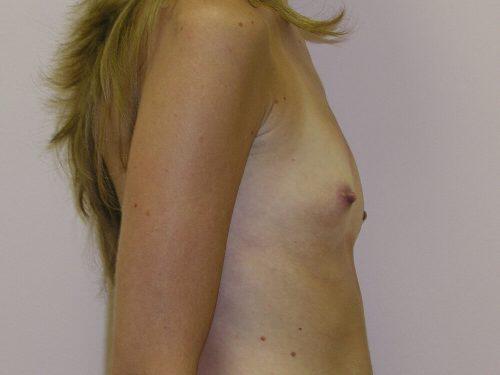 Breast Augmentation  Before & After Image