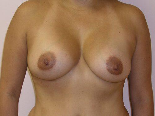 Breast Augmentation  Before & After Image