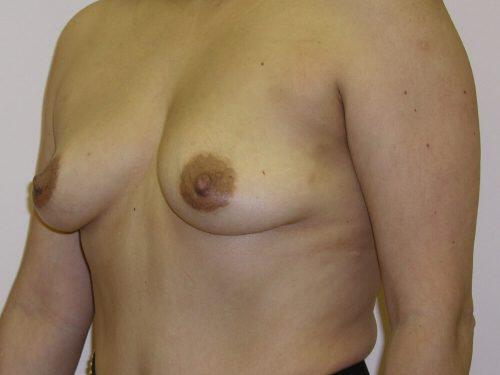 Breast Augmentation  Before & After Image