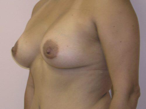 Breast Augmentation  Before & After Image