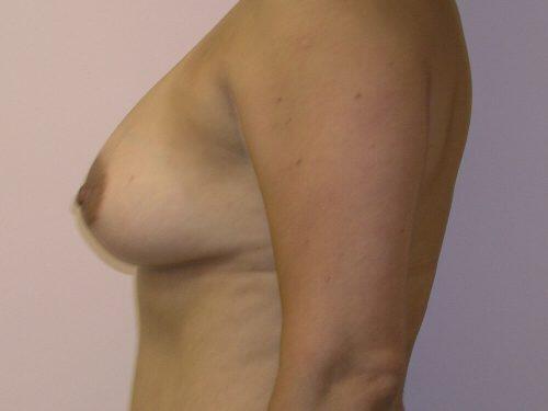 Breast Augmentation  Before & After Image