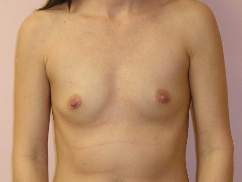 Breast Augmentation  Before & After Image