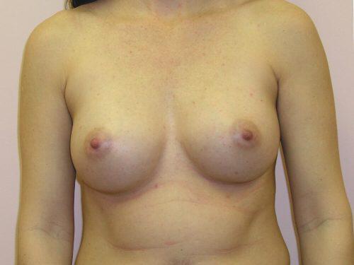 Breast Augmentation  Before & After Image