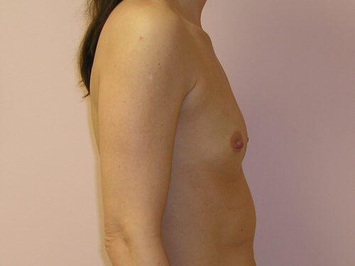 Breast Augmentation  Before & After Image