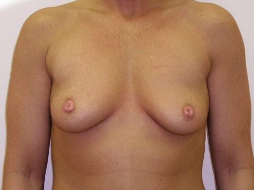 Breast Augmentation  Before & After Image