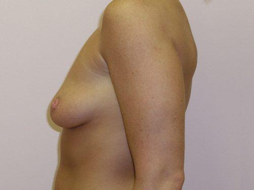 Breast Augmentation  Before & After Image