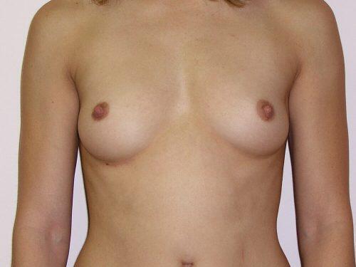 Breast Augmentation  Before & After Image