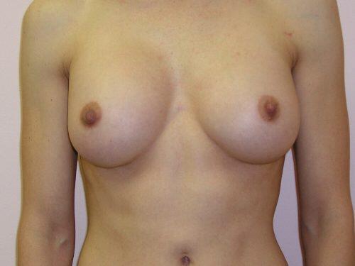 Breast Augmentation  Before & After Image