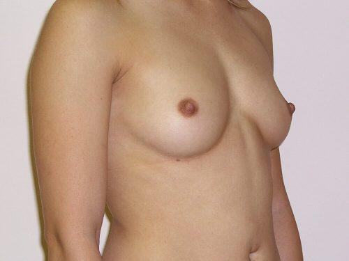 Breast Augmentation  Before & After Image