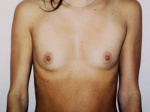 Breast Augmentation  Before & After Image