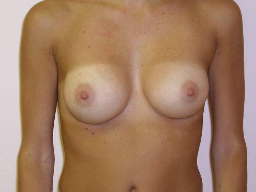 Breast Augmentation  Before & After Image