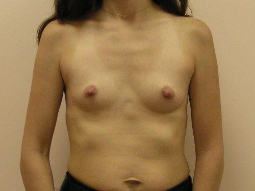 Breast Augmentation  Before & After Image